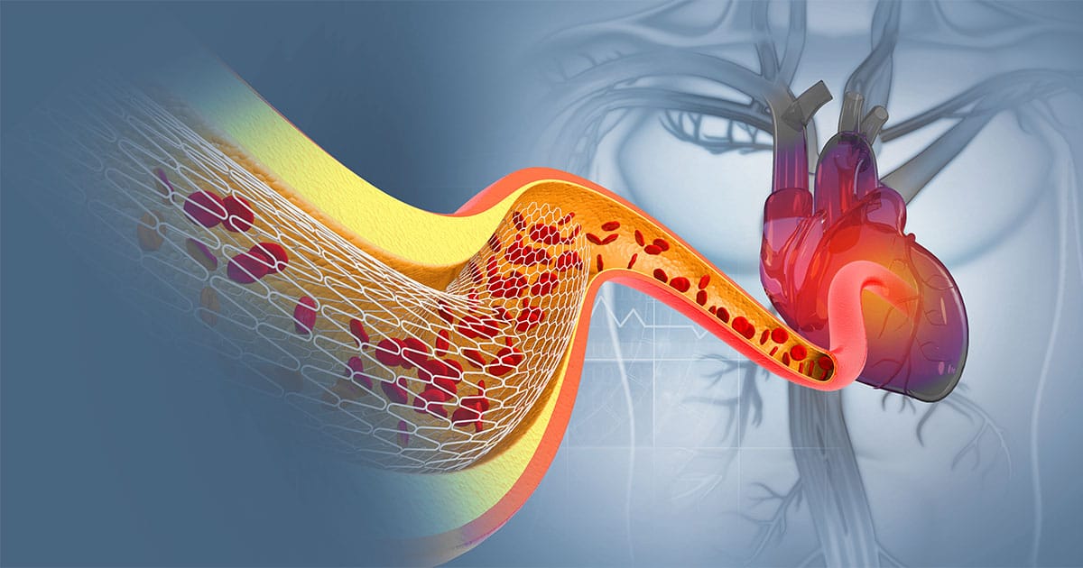 Peripheral Interventional Procedures | Ibrahim Heart Clinic