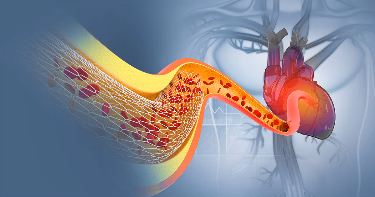 Peripheral Interventional Procedures | Ibrahim Heart Clinic